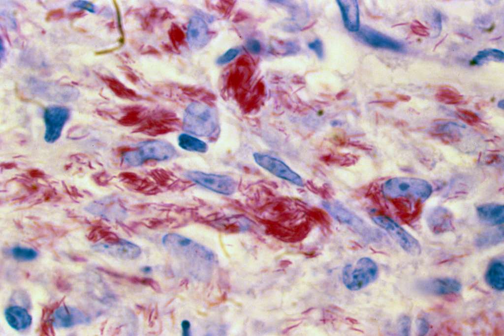 La lèpre est une maladie grave et stigmatisante. © Institut Pasteur, Pierre Ravisse