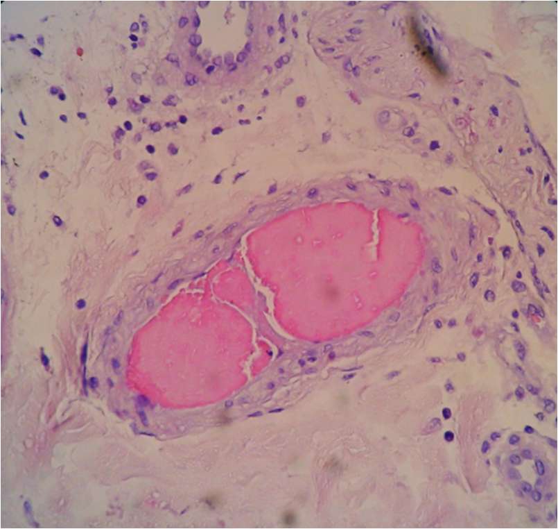 Un vaso sanguigno nella pelle è circondato da crioglobuline, che sono anticorpi che si depositano al freddo.  © Orivaldo Alves Barbosa et al., American Journal of Medical Case Reports, 2016