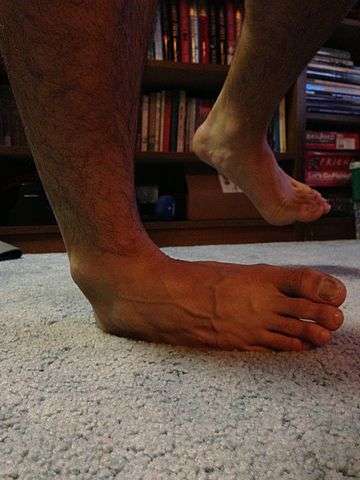 Mouvement d'inversion du pied pouvant entraîner une déchirure des ligaments rattachés à la malléole. © Barney Stinson 13, Wikipedia Commons, CC by-sa 3.0