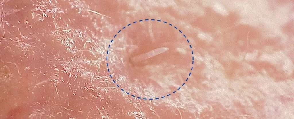 Une vue au microscope de Demodex folliculorum, la tête enfoncée dans un pore de notre peau. © Université de Reading
