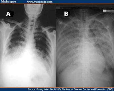 Aspects radiographiques de l'atteinte pulmonaire. © Center for disease control and prevention, reproduction et utilisation interdites