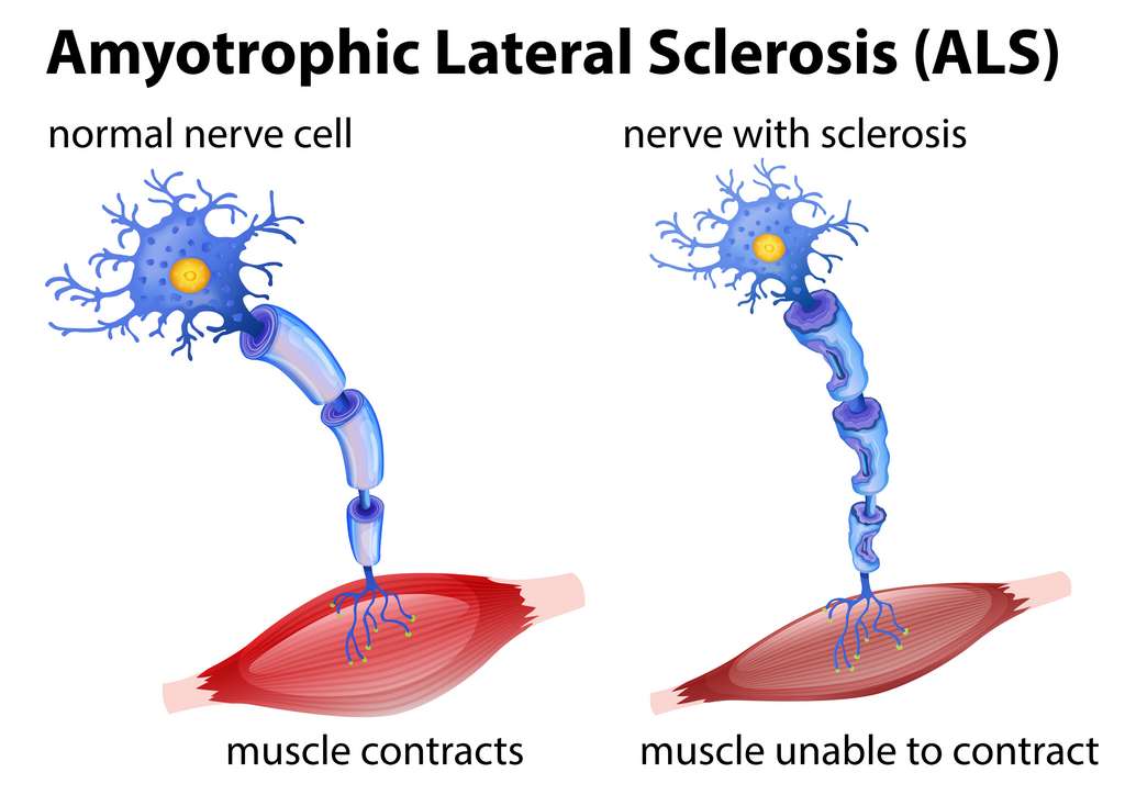 Schéma simplifié de la maladie de Charcot ou sclérose latérale amyotrophique. À gauche, la liaison entre les motoneurones et les muscles se fait normalement. À droite, la liaison est empêchée par la sclérose des motoneurones, provoquant ainsi les symptômes de la maladie. © blueringmedia, Adobe Stock