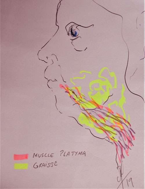 La répartition de graisse en jaune et du muscle platysma en violet. © Dr Mitz, tous droits réservés La répartition de graisse en jaune et du muscle platysma en violet. © Dr Mitz, tous droits réservés