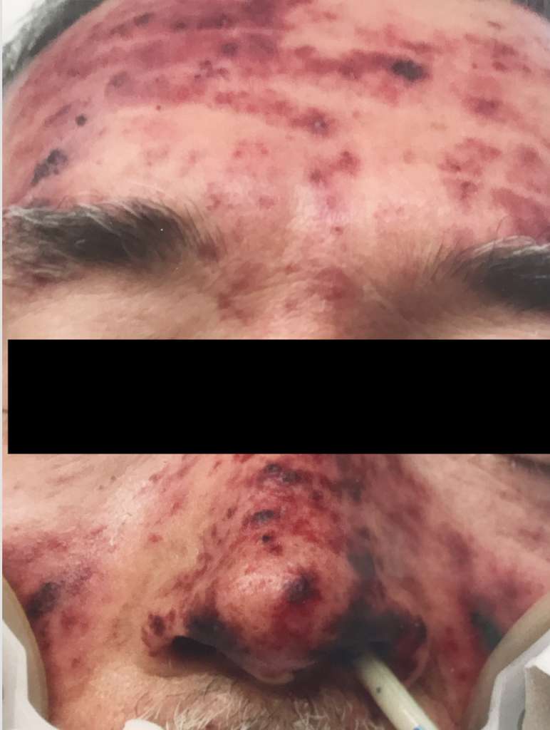 La pétéchie faciale du patient quelques jours après son admission. © Naomi Mader, European Journal of Case Reports in Internal Medicine