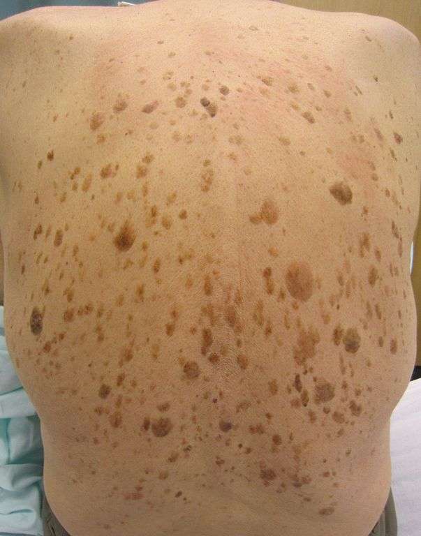  Une multitude de lésions de kératose séborrhéique sur le dos d'un patient. © James Heilman, MD, Wikipédia Commons, CC by-sa 3.0