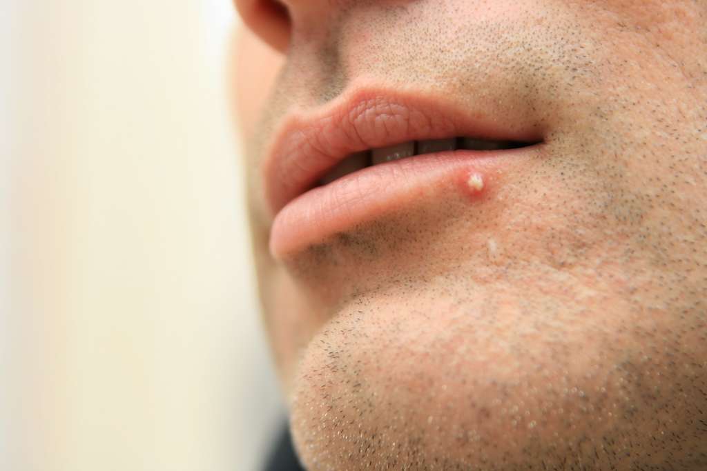 Le bouton d’acné prend la forme d’un petit point blanc entouré de rouge sur le bord de la lèvre. © Marc Roche, Adobe Stock