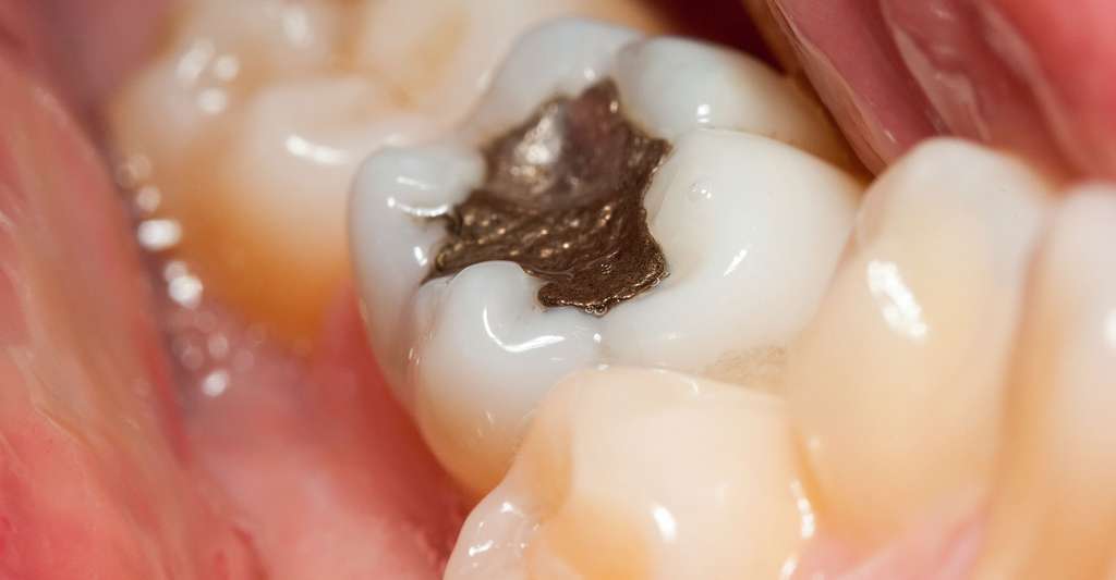 Amalgame dentaire à base de mercure. © Szasz-Fabian Jozsef, Shutterstock