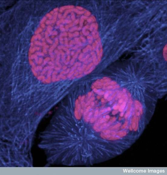 Tout cancer se caractérise par la division incontrôlée de cellules (comme celles de cette tumeur mammaire, où les chromosomes ont été colorés), rendue possible par des mutations génétiques. Les signatures laissées sur l'ADN ont été cataloguées. © David Becker, Wellcome Images, cc by nc nd 2.0