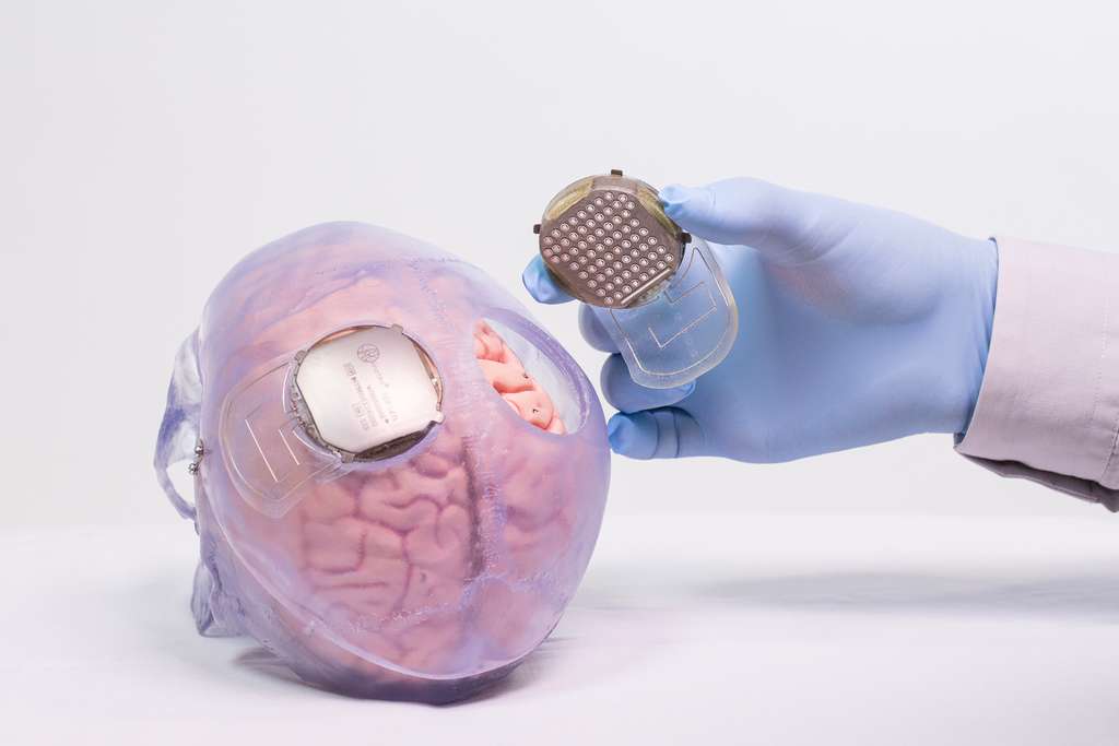 Les électrodes de la neuroprothèse implantées dans le crâne de façon à capter l'activité électrique du cerveau et à la transférer vers un ordinateur qui la décode. © LaBreche 