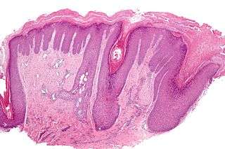  Biopsie de peau montrant une hyperkératose provoquée par un grattage excessif. © Nephron, Wikipédia Commons, CC by-sa 3.0