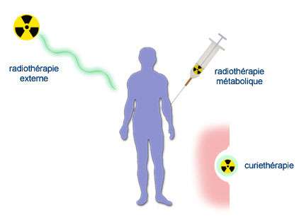 Röntgenthérapie, curiethérapie, brachythérapie, téléradiothérapie | Dossier