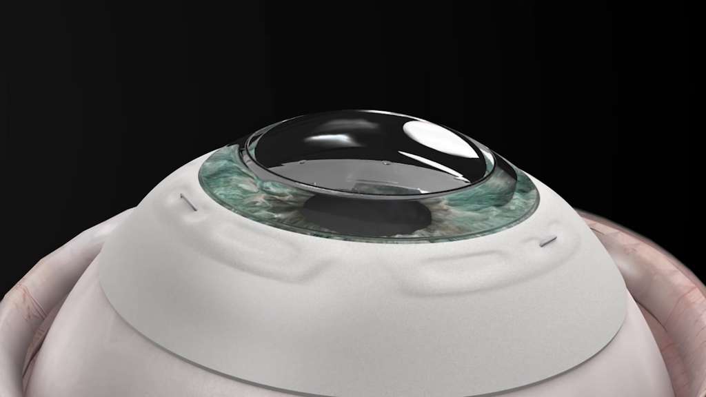 La cornée artificielle de CorNeat Vision facilite l’intégration de greffon dans l’œil. © CorNeat Vision