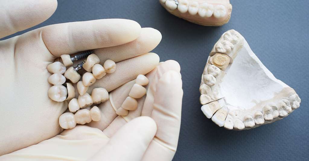 Les prothèses dentaires fixes. © Golubovy - Fotolia 
