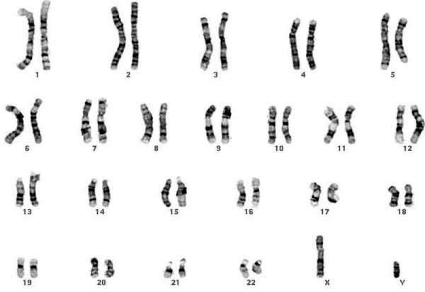 Figure 15. Caryotypes d’une cellule saine et d’une cellule cancéreuse. En haut, caryotype d’une cellule saine où l’on distingue les 23 paires de chromosomes. En bas, caryotype d’une cellule cancéreuse qui témoigne de son aneuploïdie par son nombre aberrant de chromosomes. © Pedagogie.ac-toulouse.fr/University of Pittsburgh Cancer Institute