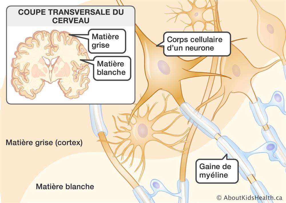 L Infection Au Coronavirus Provoque Des Petites Fuites De Sang Dans Le Cerveau