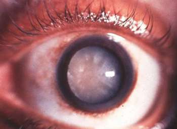 Œil atteint de cataracte. © DR 
