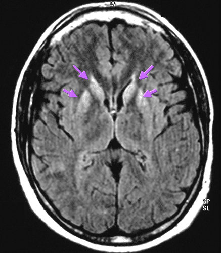 Hypersignaux striataux visibles par IRM sur un cerveau de patient atteint de la maladie de Creutzfeldt-Jakob. © www.creutzfeldt-jakob.aphp.fr