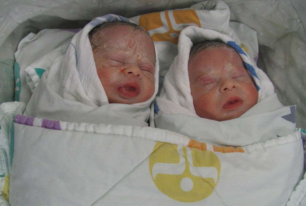 Avant l’apparition de la chirurgie contre le STT, le pronostic était mal engagé pour les bébés. Désormais, les deux jumeaux survivent dans 65 % des cas. © Miss pupik, Flickr, cc by 2.0