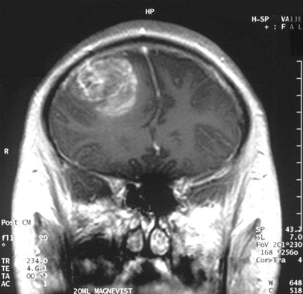 Le glioblastome est la tumeur au cerveau la plus agressive. Il ressort nettement sur cette image prise en IRM sur un jeune garçon de 15 ans. Le taux de survie est malheureusement très faible. Une solution efficace est donc la bienvenue. Pourquoi pas les nanoparticules ? © A. Christaras, Wikipédia, cc by sa 3.0