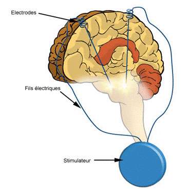 Principe de la stimulation cérébrale profonde. Source : La maladie de Parkinson, site du laboratoire GSK. © photos/illustrations : © Laboratoire GlaxoSmithKline - www.gsk.fr