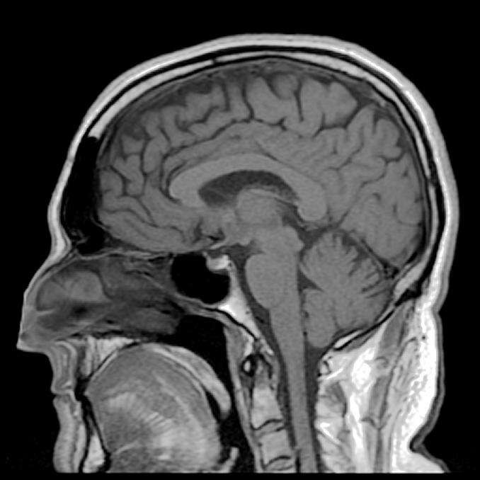 L'imagerie par résonance magnétique (IRM) permet d’étudier le cerveau et d’observer des éventuelles lésions. Au cours de cette analyse, l’IRM a révélé une augmentation des altérations de la substance blanche chez les personnes migraineuses. Reste à savoir si cela impacte les fonctions mentales. © Reigh LeBlanc, Flickr, cc by nc 2.0