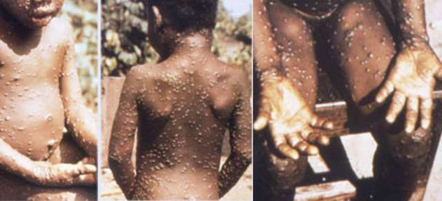 Éruption cutanée liée à la variole du singe chez un enfant. © CDC, Wikipédia Commons, Domaine Public