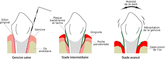 Évolution des maladies parodontales (ou gingivales) qui est toujours l’aggravation d’une autre pathologie antérieure et mal soignée. © DR