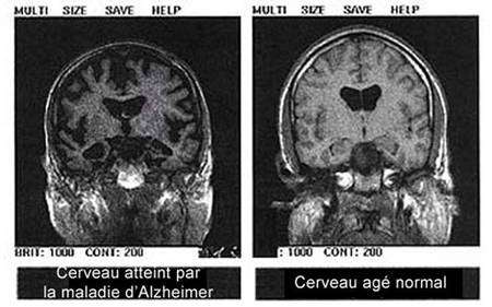Diagnostic de la maladie d'Alzheimer | Dossier