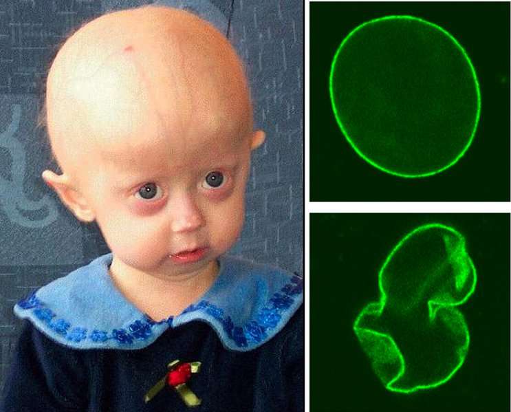 Les enfants atteints de progéria souffrent de vieillissement accéléré. Physiquement, on peut le voir par la finesse de la peau et la perte des cheveux. L'image en haut à droite représente un noyau cellulaire normal, celui d'en bas, un noyau déformé au cours d'une progéria. © Plos, Wikipédia CC by 2.5