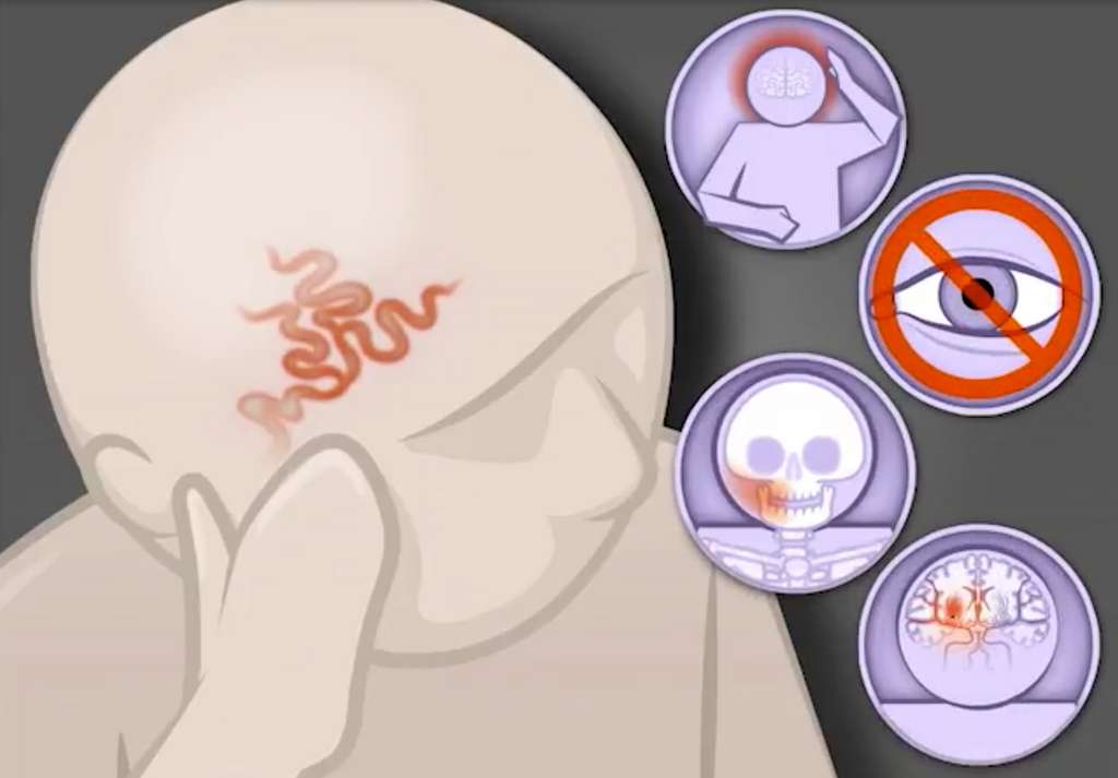 La maladie de Horton se traduit par des maux de tête, une perte de vision, une claudication de la mâchoire ou des accidents vasculaires cérébraux. © NEJMvideo, Youtube