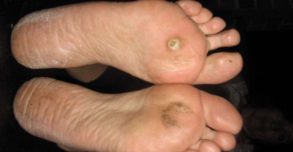 papillomavirus verrue pied