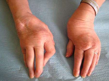 Mains d'une personne atteinte de polyarthrite rhumatoïde. © Cind
