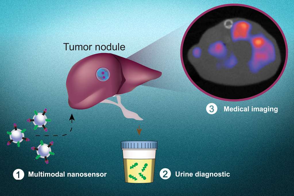 Les nanoparticules synthétiques servent à la fois à détecter les tumeurs dans l’urine et à les localiser à l’imagerie topographique. © Liangliang Hao
