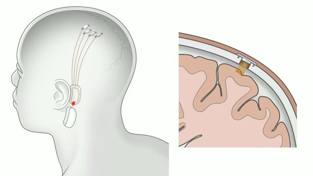 Elon Musk hit the headlines 10 days ago by claiming that his start-up Neuralink had achieved an experiment in which a monkey was controlling a computer directly from his brain.  Â© Courtesy of YouTube, Neuralink