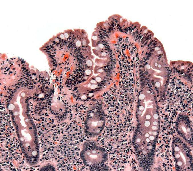 Atrophie villositaire d'un intestin grêle d'un patient atteint de la maladie coeliaque, visualisée au microscope optique. © Samir / Licence Creative Commons