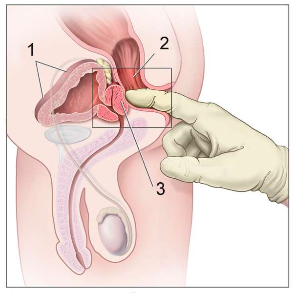 prostate homme prostata screening vgr