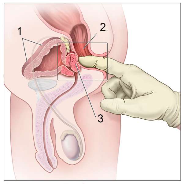 problème de prostate à 20 ans