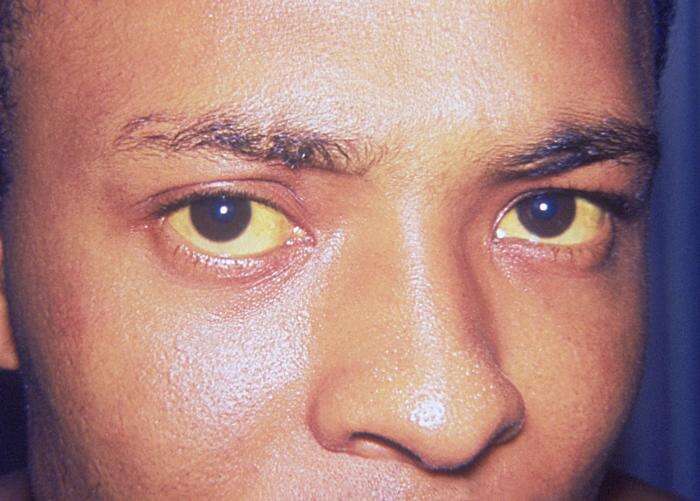 Une personne atteinte de jaunisse dont la couleur des yeux est caractéristique. © Thomas F. Sellers, Emory University, DP