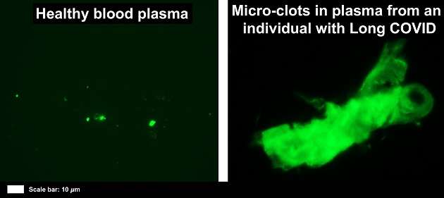 À gauche, un plasma sain. À droite, un microcaillot présent chez un individu atteint de Covid long. © Etheresia Pretorius et al., Cardiovascular Diabetology