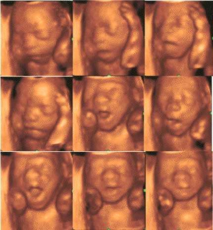 Bâillements de fœtus. © Olivier Walusinski, tous droits réservés