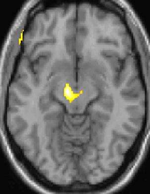Marquage du débit sanguin sur certaines zones du cerveau, ici en 2D. Sur une image en 3D, les éléments de base, en volume, sont des voxels. © Arne May, Wikimedia Commons, cc by sa 3.0