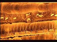 Organe de Corti de cobaye après traitement par un antibiotique aminoglycosidique (gentamicine). On observe la présence de cellules ciliées internes avec altération des stéréocils. © Inserm Organe de Corti de cobaye après traitement par un antibiotique aminoglycosidique (gentamicine). On observe la présence de cellules ciliées internes avec altération des stéréocils. © Inserm