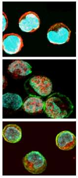 Image du haut : cellules dendritiques (dites plasmocytoïdes) en l’absence d'agression. La protéine IRF-7 (en rouge) reste dans le cytoplasme, à la périphérie du noyau (en bleu). Image du milieu : les cellules répondent à une attaque (simulée). La protéine IRF-7 (en rouge) est entrée dans le noyau et déclenche la réponse immunitaire innée. Image du bas : la protéine PI3-kinase a été inhibée. Même face à une agression, la protéine IRF-7 ne pénètre plus dans le noyau et ne peut donc plus jouer son rôle. © Cristiana Guiducci/Institut Curie