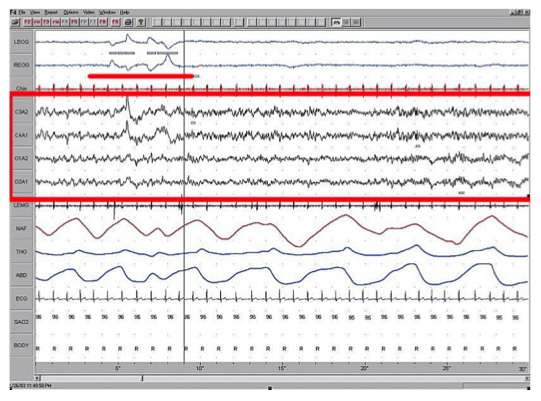La phase de sommeil paradoxal. En rouge, le tracé de l’électroencéphalogramme. Au-dessus, les mouvements oculaires (électro-oculogramme). © Wikimedia Commons, DR