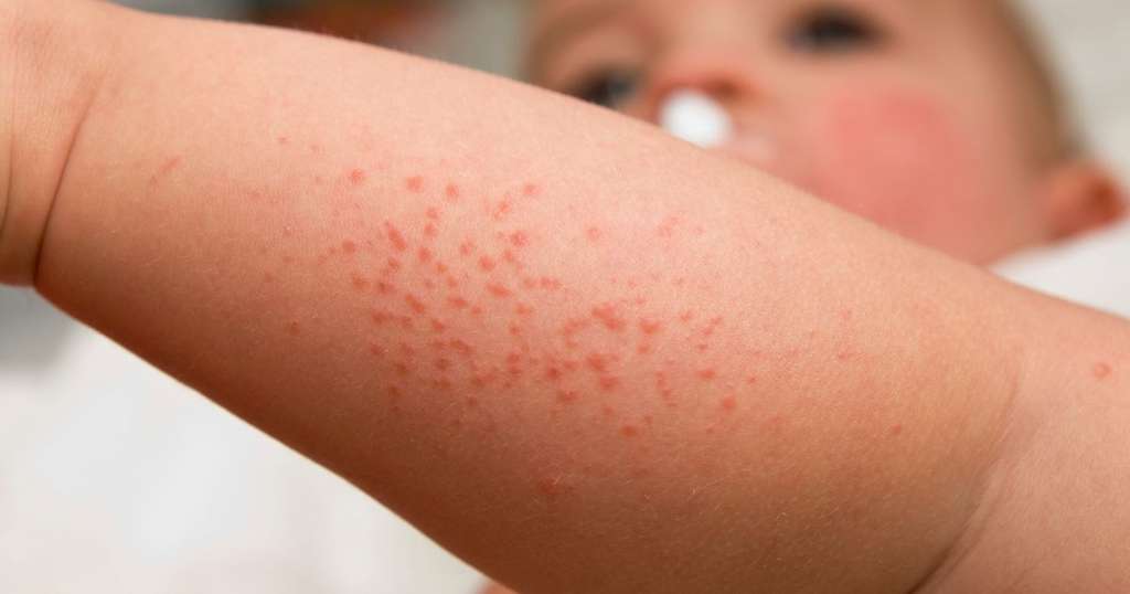 Exemple d'un rash (éruption) sur la peau d'un jeune enfant. © domaine public