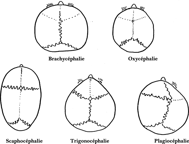 Principales formes de craniosténoses. Les sutures anormalement fermées sont représentées en pointillés. © P. Dhellemmes et al, Annales françaises d'anesthésie et de réanimation, 2002