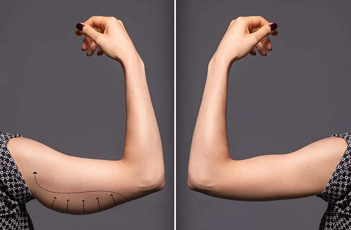 Avant et après une brachioplastie. © Alessandro Grandini, Adobe Stock