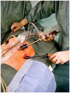 En chirurgie laparoscopique conventionnelle, le chirurgien manipule directement les instruments qui pénètrent à l’intérieur du patient. Il n’est pas tenu à distance. © Département d'urrologie - clinique des franciscaines - Versailles