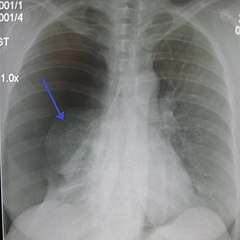 Radiographie d'un pneumothorax unilatéral. © James Heilman, Commons Wikimedia CC by-sa 3.0