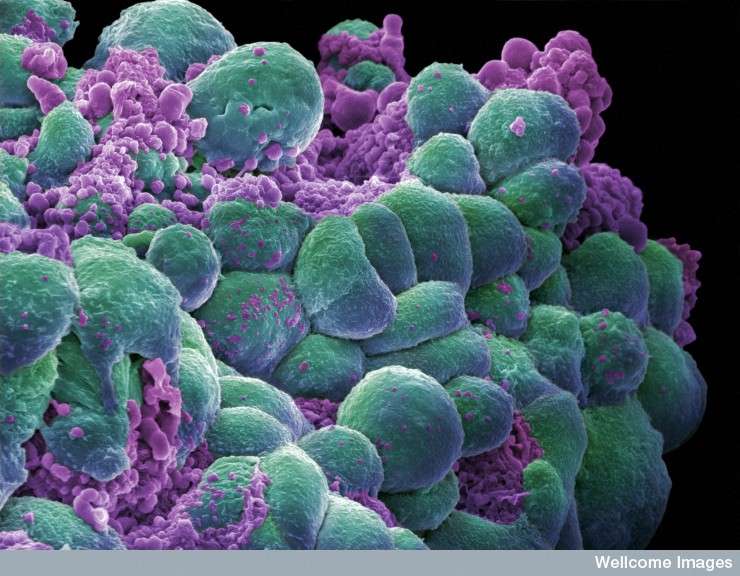Le cancer du sein, dont on voit des cellules à l'image, est souvent sous l'influence des œstrogènes. Les perturbateurs endocriniens, qui peuvent avoir les mêmes effets physiologiques que l'hormone féminine, pourraient donc contribuer au développement des tumeurs mammaires. © Annie Cavanagh, Wellcome Images, Flickr, CC by-nc-nd 2.0